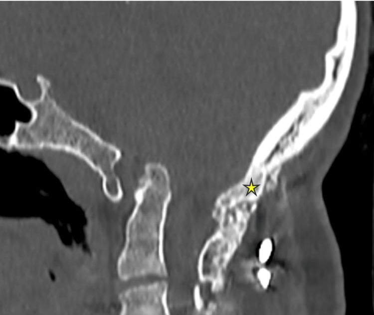 Sagittal follow-up CT showing thick trabecular fusion mass from the occiput to the C2 lamina after occipitocervical fusion.