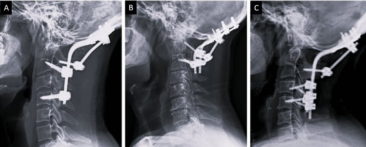 Serial lateral cervical radiographs showing an occiput-to-C5 three-rod occipitocervical fusion construct at follow-up.
