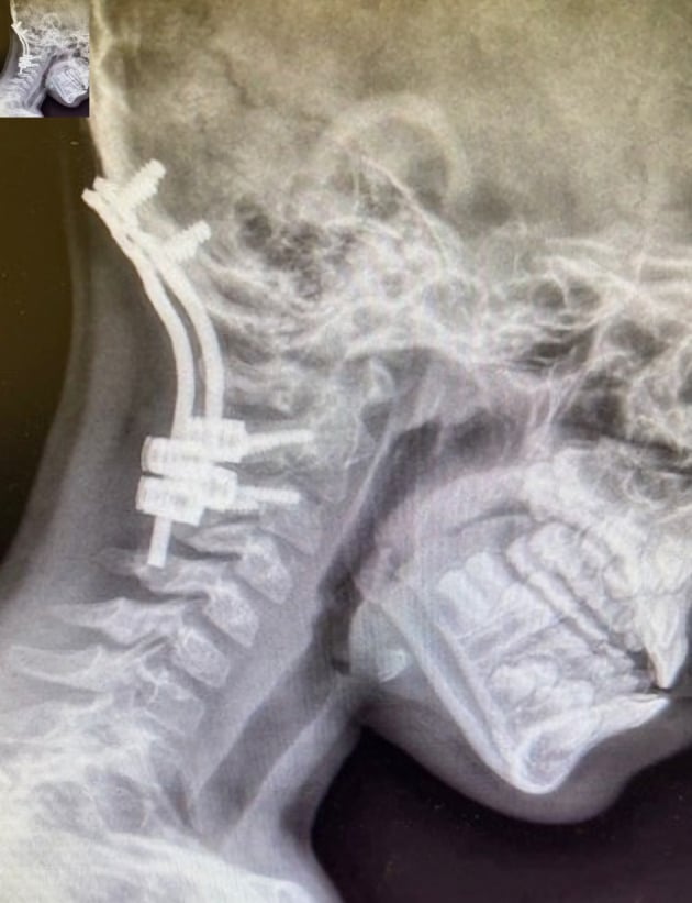 Lateral cervical radiographs showing occipitocervical instrumentation used to stabilise paediatric atlanto-occipital dislocation.