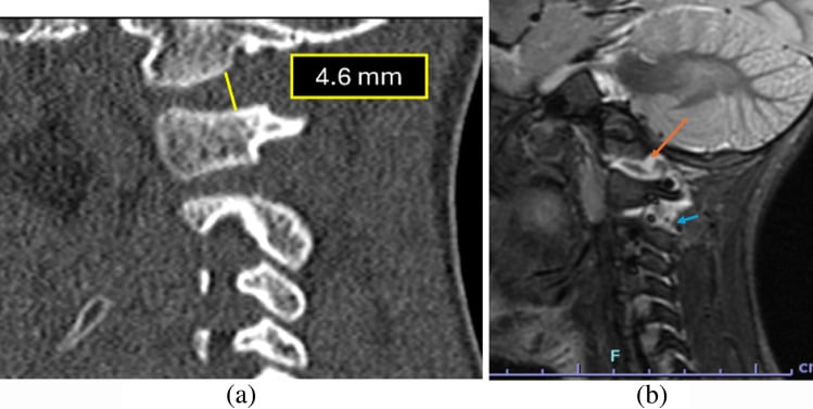 Sagittal CT and MRI showing a widened V-shaped occipital-condyle to C1 interval with joint fluid and interspinous soft-tissue injury in paediatric AOD.