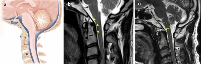 Sagittal craniovertebral-junction dissection with normal and torn tectorial membrane appearances on T2 MRI.