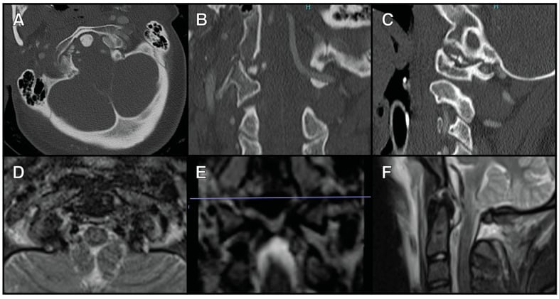 Multiplanar CTA and STIR MRI showing a type III occipital condyle avulsion fracture with alar and posterior ligament disruption.