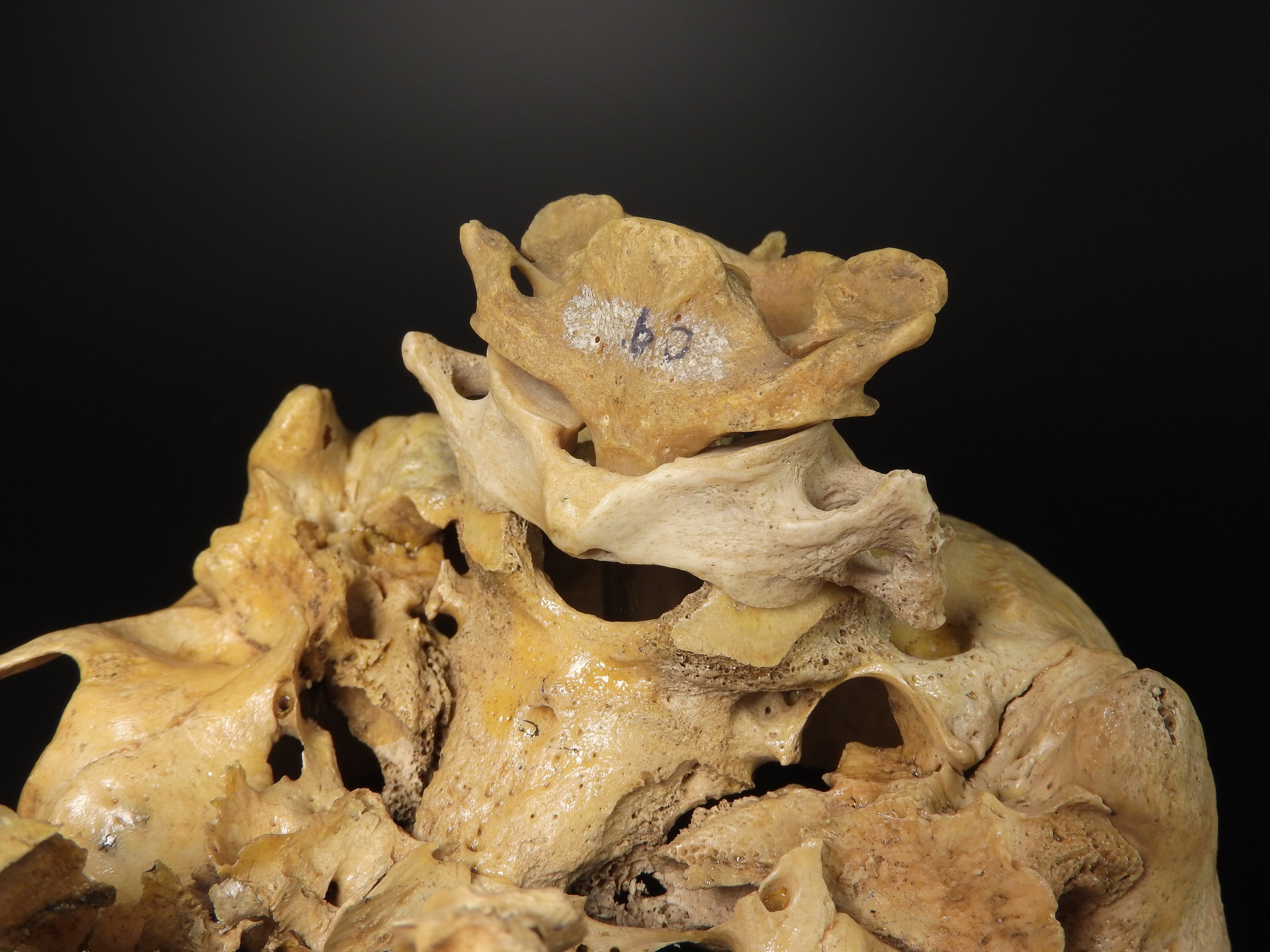Anatomical bone specimen showing atlas (C1) and axis (C2) vertebrae at craniovertebral junction