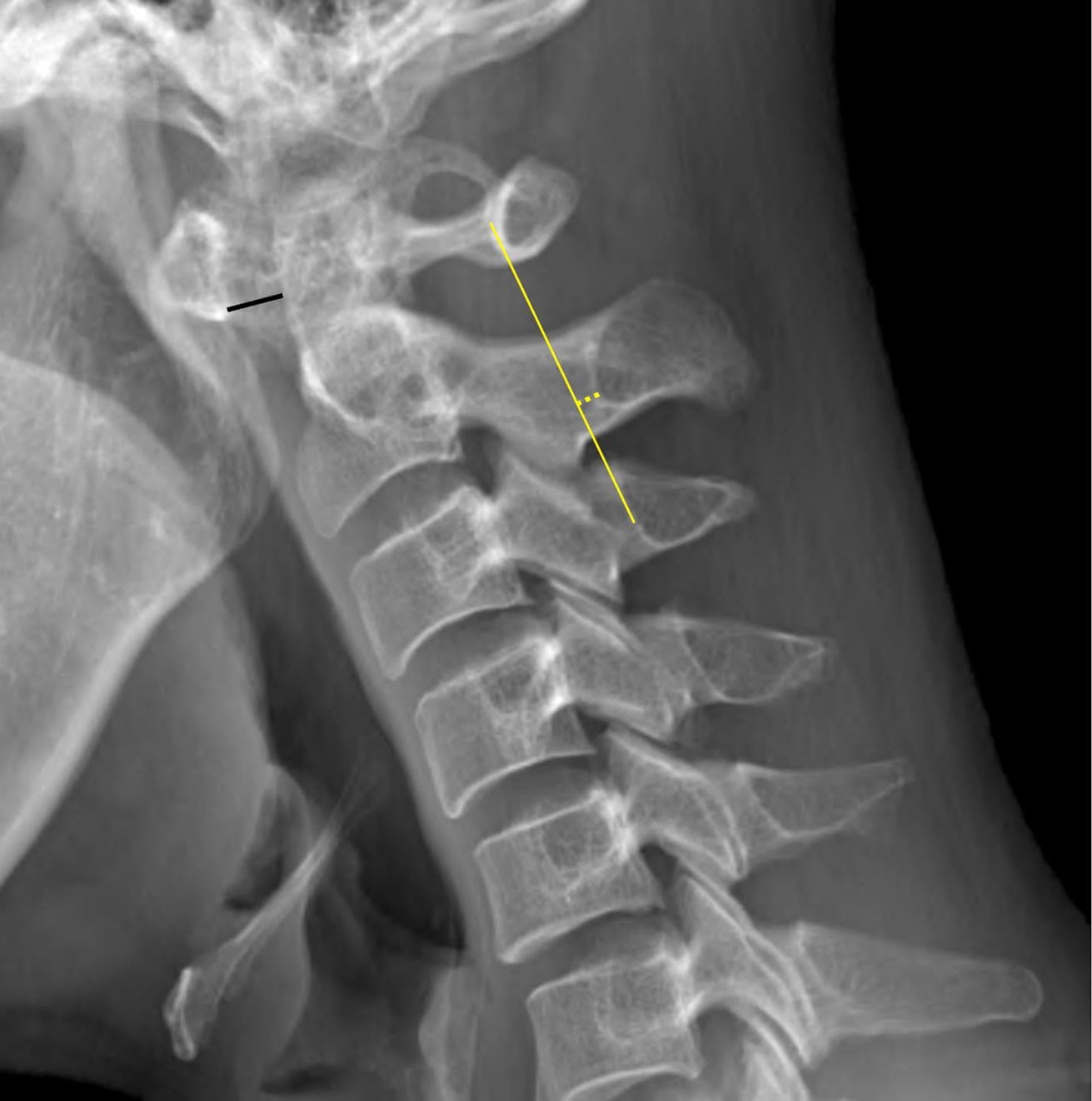 Lateral cervical radiograph showing anterior atlantodental interval and Swischuk-line measurements