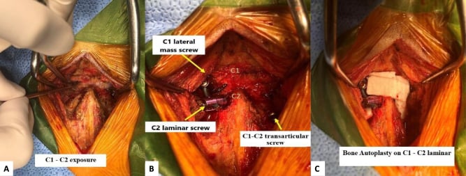 Operative photographs showing C1-C2 exposure, labelled C1 lateral mass, C2 laminar and C1-C2 transarticular screws, and posterior bone grafting
