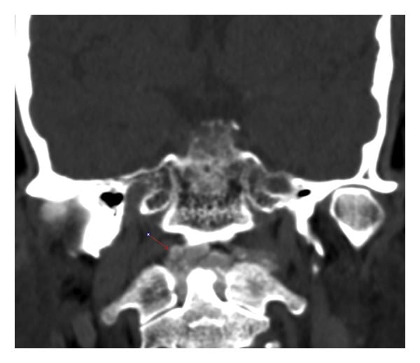 Coronal CT showing curvilinear calcification around the odontoid process