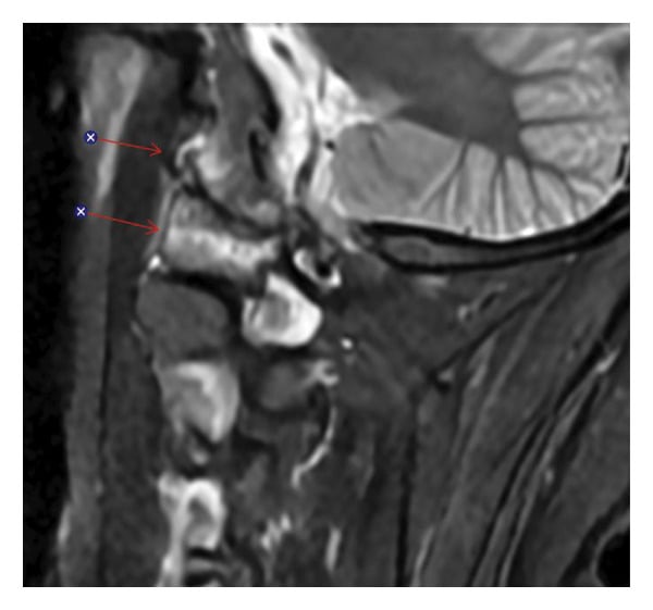 Sagittal MRI showing upper cervical marrow and adjacent soft-tissue oedema in crowned dens syndrome