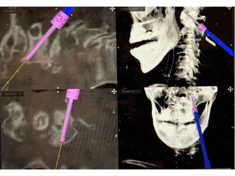 Multiplanar intraoperative navigation views during C1 lateral-mass screw insertion
