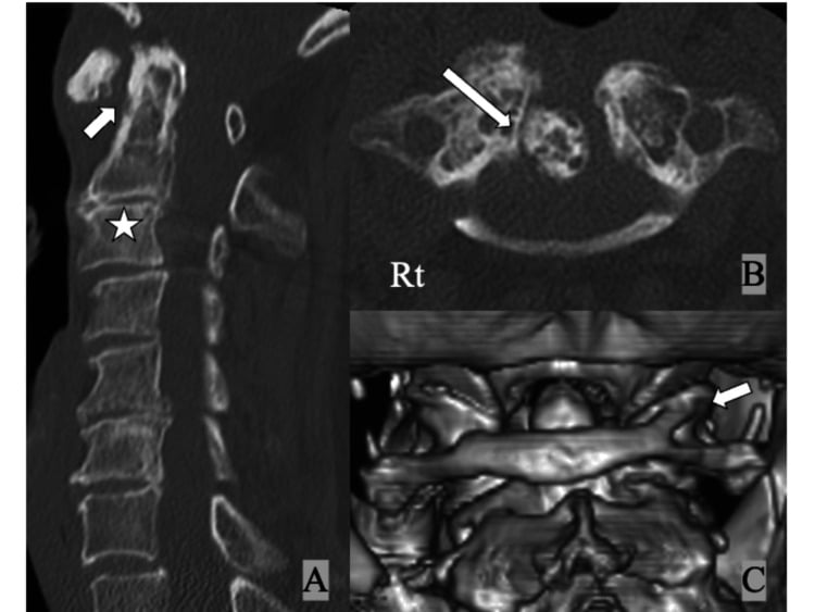 CT showing a widened atlantodental interval, an osteophyte around the dens and a complete ponticulus posticus