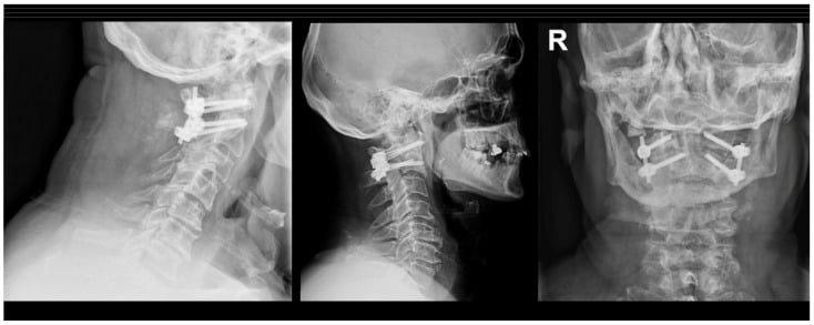 Lateral and AP radiographs after posterior C1-C2 fusion
