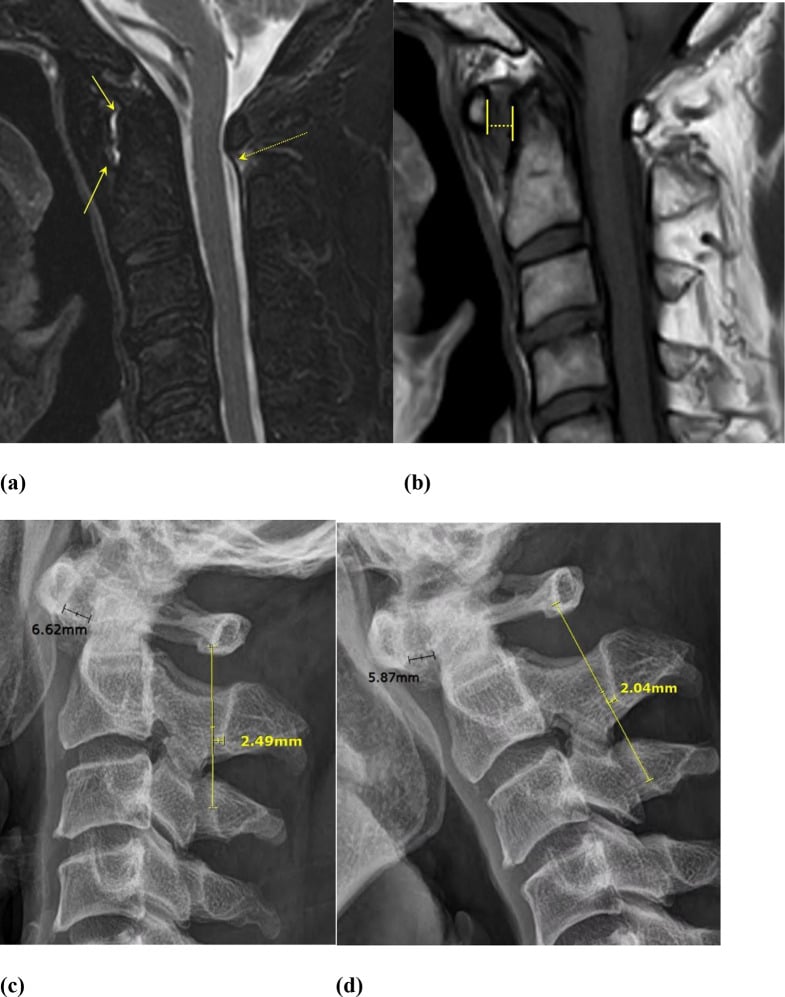 MRI and lateral cervical radiographs showing rheumatoid atlantodental subluxation and measurement changes