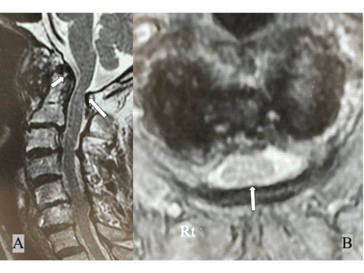 Sagittal and axial cervical MRI showing synovitis around the dens and mild cord compression