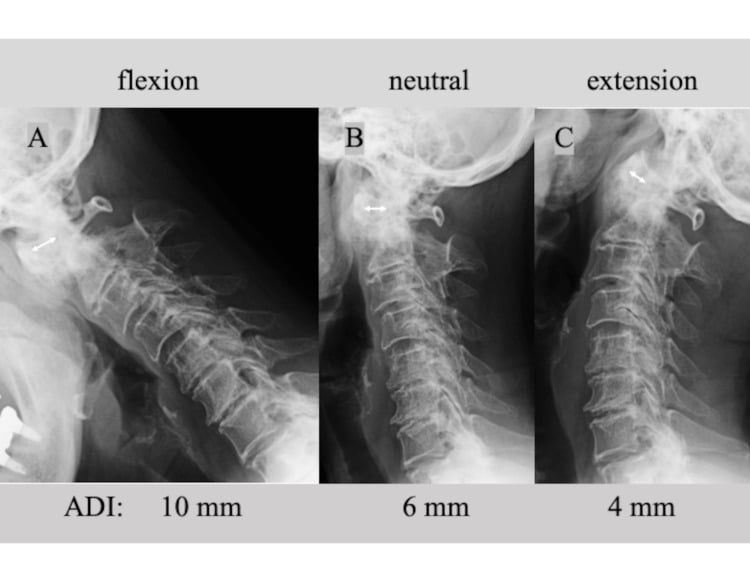 Lateral flexion, neutral and extension radiographs with atlantodental intervals of 10 mm, 6 mm and 4 mm