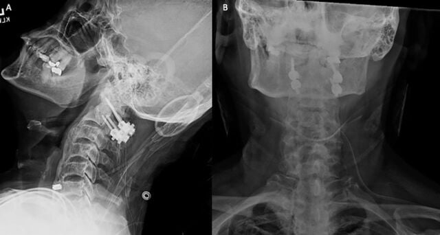 Lateral and anteroposterior cervical radiographs of a C1 lateral mass and C2 pars screw-rod construct