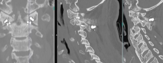 Coronal and paired sagittal CT showing solid arthrodesis through bilateral C1-C2 intrafacet spacers