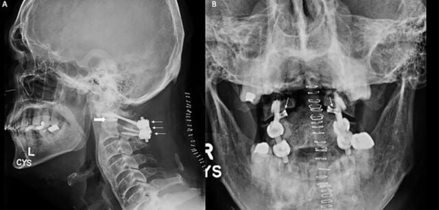 Lateral and anteroposterior radiographs after revision C1-C2 fixation with intrafacet spacers at both lateral atlantoaxial joints