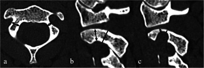 Axial and sagittal CT comparing a normal C2 pedicle and isthmus with a high-riding vertebral artery narrowing the isthmus