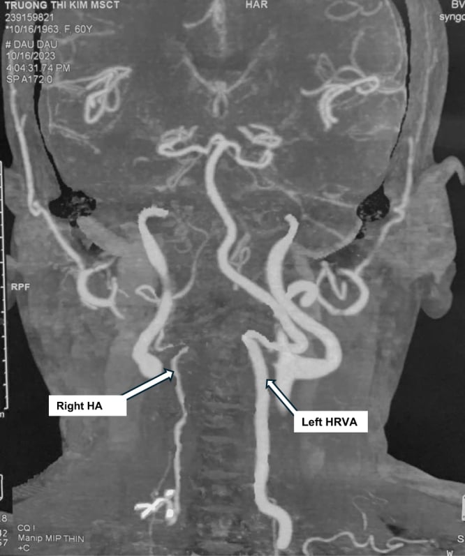 CT angiogram showing a hypoplastic right vertebral artery and a high-riding left vertebral artery