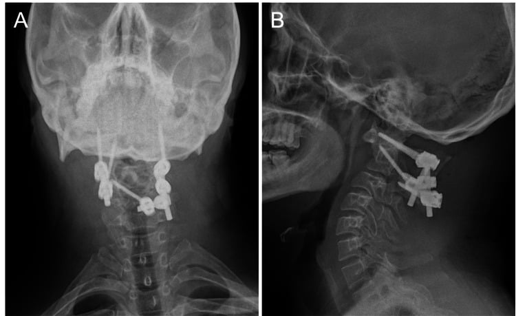 Anteroposterior and lateral radiographs of C1 lateral mass screws with a hybrid C2 construct of pars and intralaminar screws