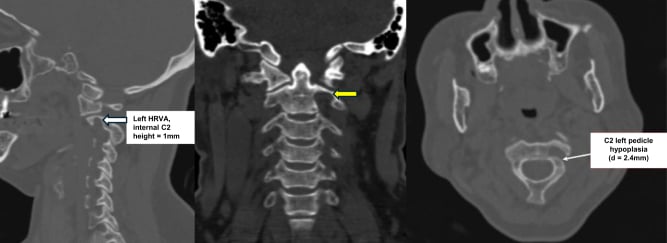 Sagittal CT through C2 showing a high-riding vertebral artery narrowing the left C2 isthmus and pedicle