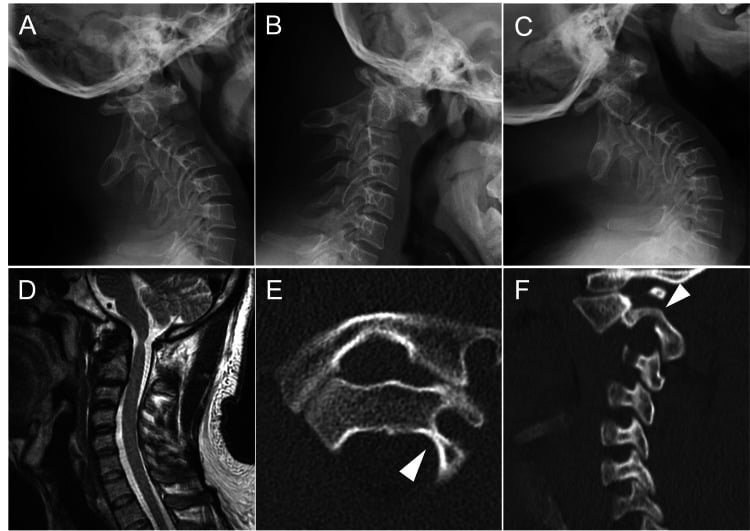 Neutral, flexion and extension lateral radiographs of persistent atlantoaxial subluxation plus sagittal T2 MRI of cord atrophy