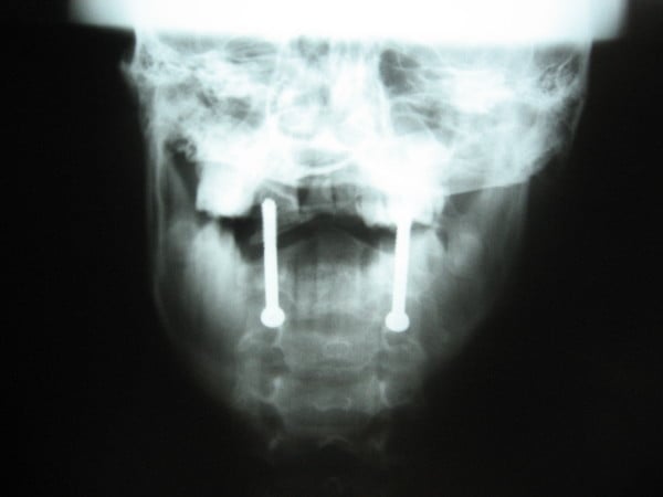 Open-mouth anteroposterior radiograph showing bilateral transarticular screws crossing the C1-C2 joints