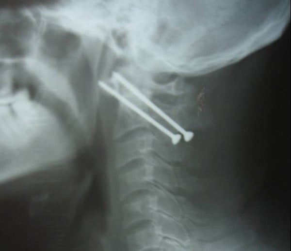 Lateral cervical radiograph with two transarticular screws crossing the reduced C1-C2 joints