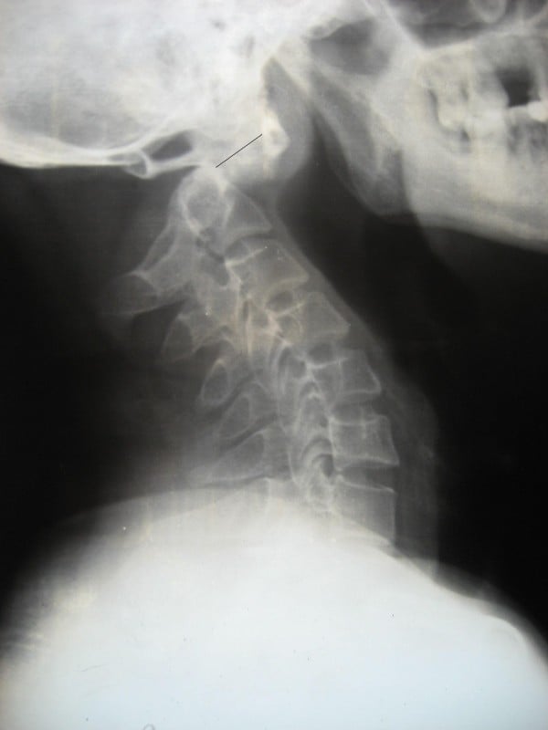 Lateral cervical radiograph showing marked atlantoaxial displacement after a type II odontoid fracture