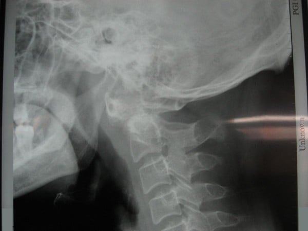 Lateral cervical radiograph after skeletal traction showing reduction of the atlantoaxial displacement