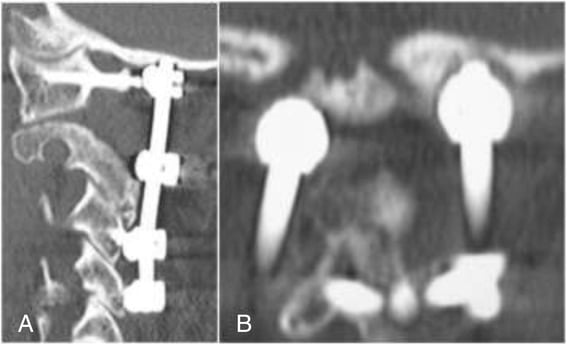 Sagittal and coronal CT six months after C1-C4 fusion showing the rod tip protruding into and eroding the occipital bone