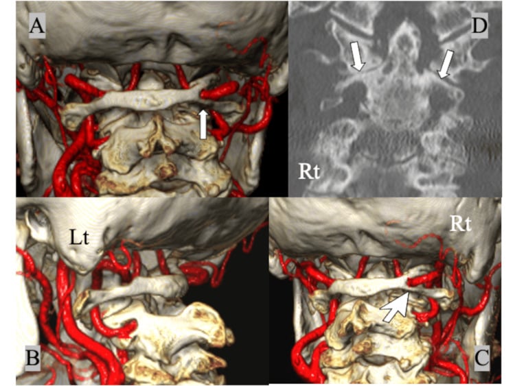 Three-dimensional CT angiogram of a complete right ponticulus posticus encircling the vertebral artery, with a normal left groove
