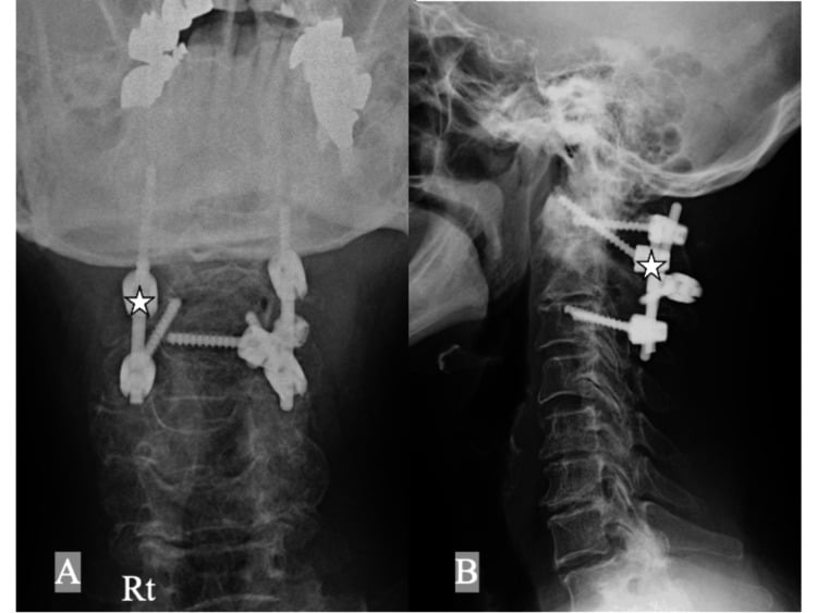Anteroposterior and lateral radiographs after C1-C3 fusion with a right C1 lateral mass screw inserted caudal to the C2 nerve root