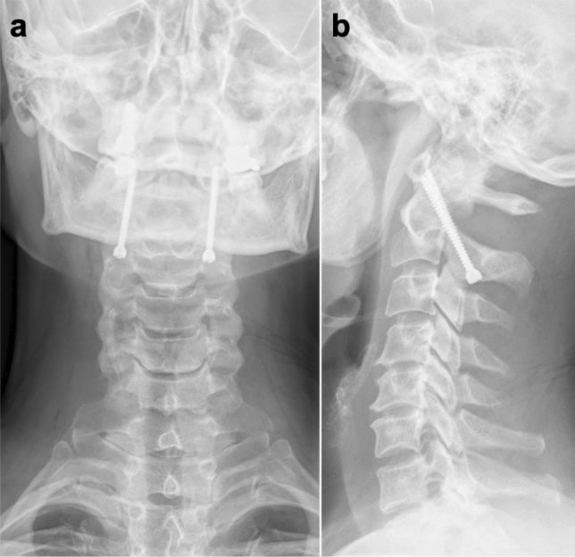 Anteroposterior and lateral radiographs of correctly placed isolated percutaneous C1-C2 transarticular screws