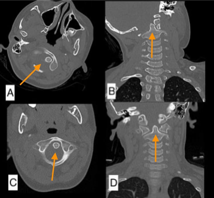 Axial and coronal CT before and after closed reduction of atlantoaxial rotatory subluxation