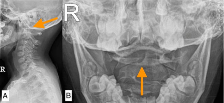 Lateral and open-mouth cervical radiographs showing asymmetric odontoid-lateral mass intervals and rotation