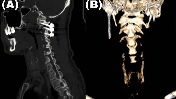 Sagittal and 3D CT ten months after surgery showing reduced locked facet and C1-C2 fusion alignment