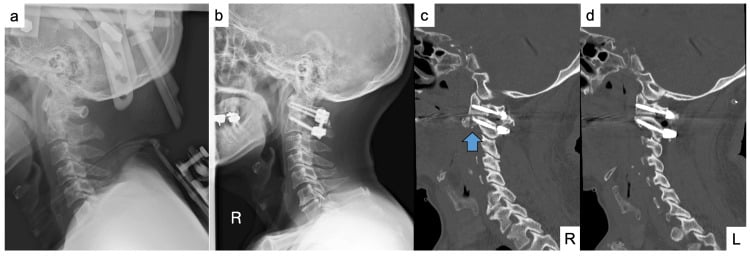 Radiographs and sagittal CT after closed reduction and posterior fixation of atlantoaxial rotatory subluxation