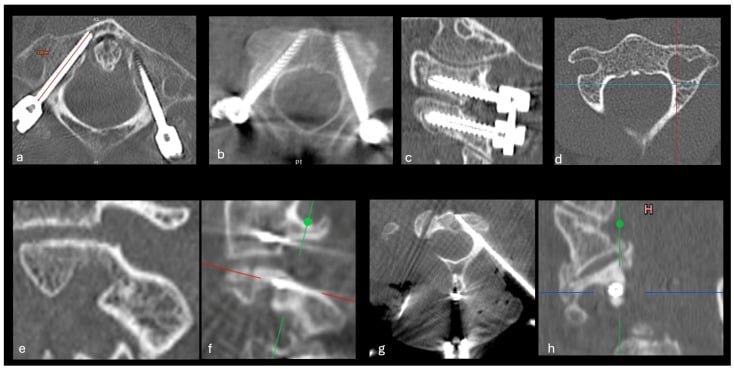 Intraoperative CT panels grading C1 and C2 screw containment and cortical breach