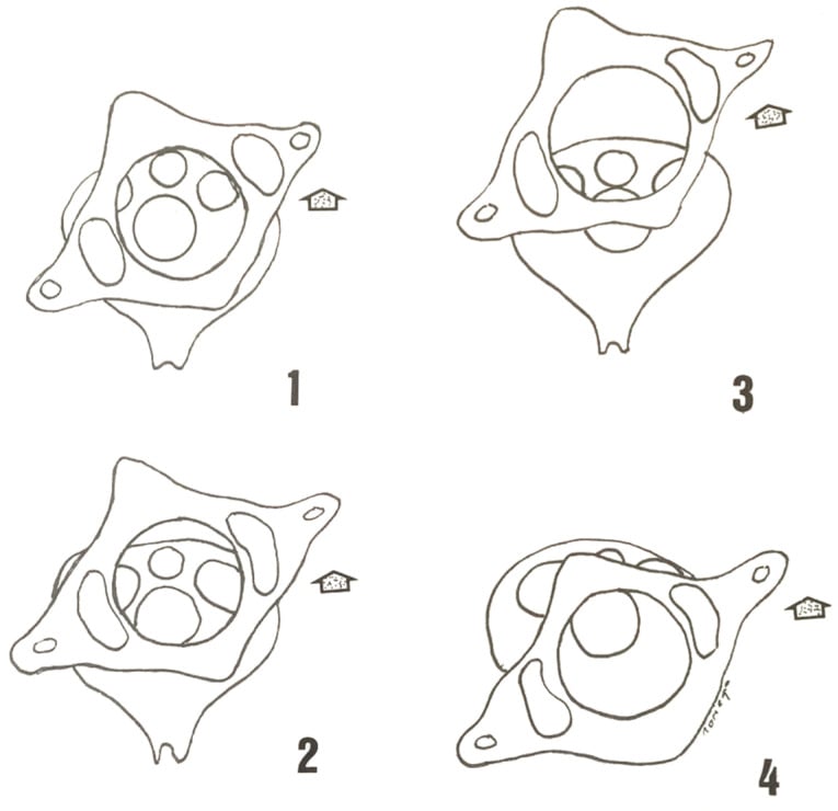 Four line diagrams showing Fielding and Hawkins types I to IV atlantoaxial rotatory subluxation