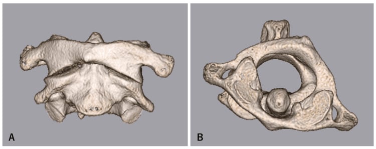 Anterior and superior 3D CT views showing fixed rotation of the atlas on the axis without ADI widening