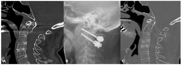 Postoperative radiograph and sagittal CT after Harms-Goel fixation showing restored C1-C2 alignment