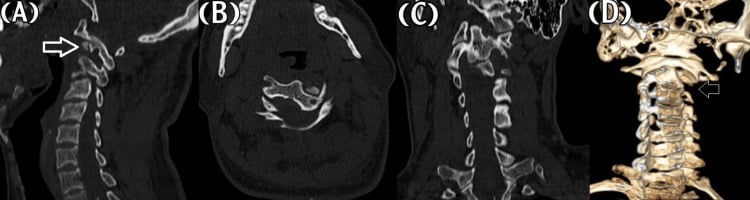 Sagittal, axial, coronal and 3D CT showing locked left atlantoaxial rotatory subluxation