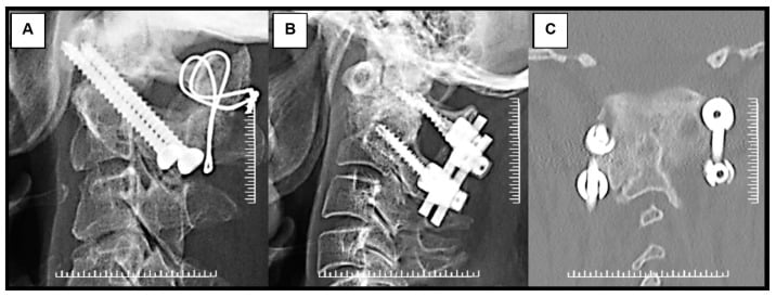 Radiographs and CT comparing Magerl transarticular screws with Harms-Goel C1 lateral-mass C2 screw-rod fixation