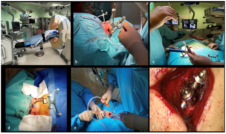 Operative sequence showing Concorde positioning, navigation reference attachment, K-wire placement and screw insertion for C1-C2 fusion