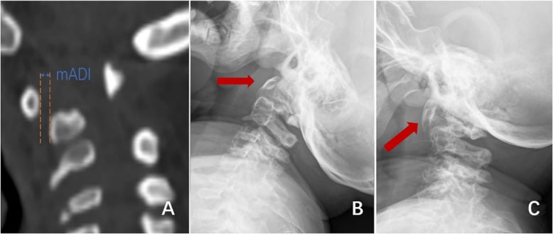 Diagram of modified atlantodental interval measurement with flexion and extension radiographs