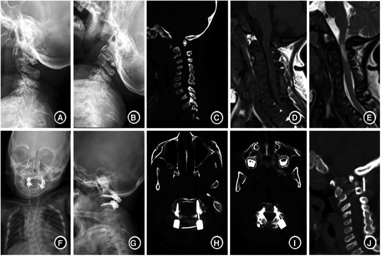 Dynamic radiographs, CT and MRI showing odontoid absence, atlantoaxial instability and cord compression in mucopolysaccharidosis