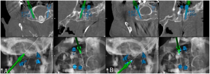 Navigation screenshots showing planned C1 lateral-mass and C2 pars screw trajectories