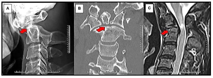 Radiograph, CT and MRI showing odontoid nonunion with atlantoaxial instability and cervical myelopathy