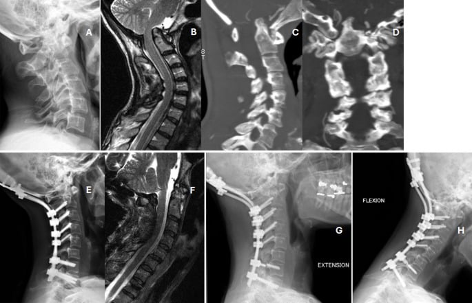 Dynamic radiographs, MRI and angiographic CT showing fixed rheumatoid atlantoaxial dislocation with vertical settling