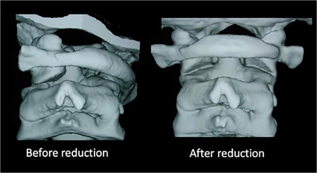 Three-dimensional CT reconstructions before and after closed reduction of paediatric atlantoaxial rotatory fixation